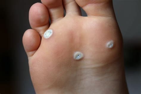 Warts On Feet Veruccas Plantar Warts Masterton Foot Clinic Nz