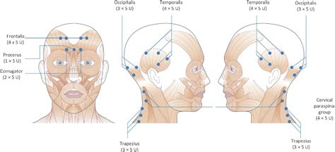 Figure 1 From Botulinum Toxin For Chronic Migraine Clinical Trials And