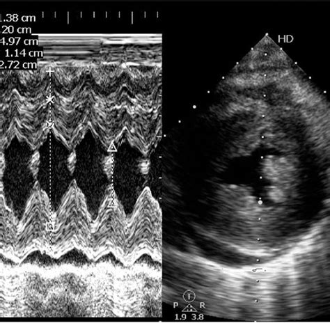 M Mode Across The Left Ventricular Cavity Showing A Good Systolic