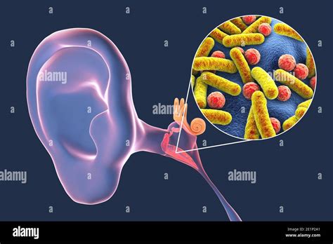 Otitis Media Ear Infection Illustration Stock Photo Alamy