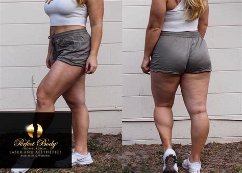 Why Cant I Get Rid Of My Cellulite Perfect Body Laser Aesthetics Long Island Ny
