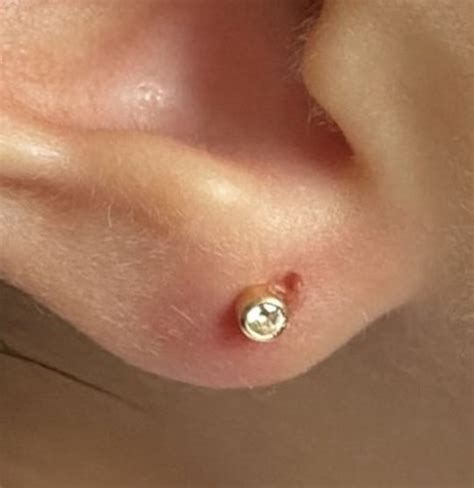 Infected Cartilage Earring Causes Symptoms And Treatment Sweetandspark