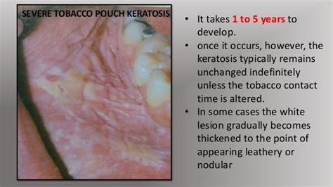 Oral Lesions Associated With The Use Of Tobacco