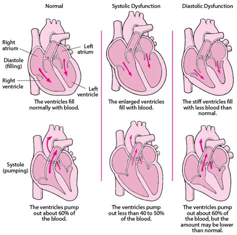 Heart Failure Hf Heart And Blood Vessel Disorders Msd Manual