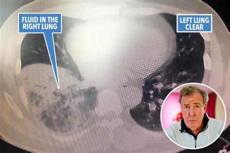 jeremy clarkson shares x ray showing just how bad his pneumonia is and jokes he needs a new