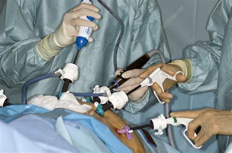 Laparoscopic Prostate Surgery Stock Image C0045131 Science Photo