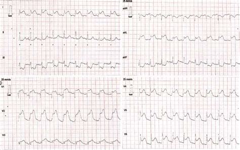12 Lead Ecg Highlighting Anterolateral St Segment Elevation With