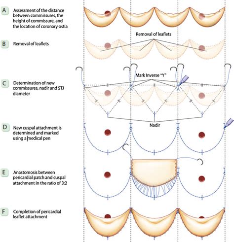 Tricuspidization Of A Quadricuspid Aortic Valve A B C D E F Download Scientific Diagram