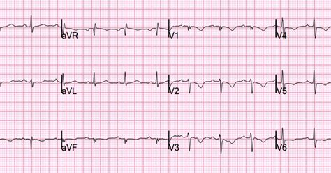 Dr Smiths Ecg Blog Chest Pain Sob Precordial T Wave Inversions