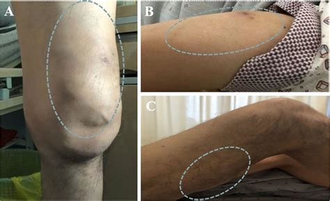 Localization Of Three Swellings In The Limbs One Soft Tissue Swelling