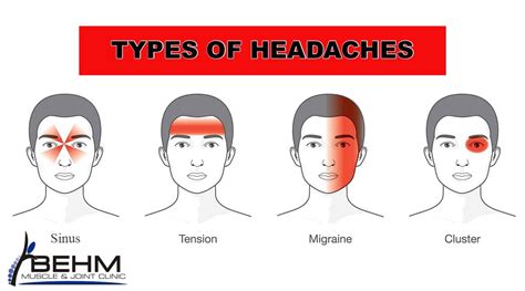 Headache Chart Types By Symptoms Location And Causes 45 OFF