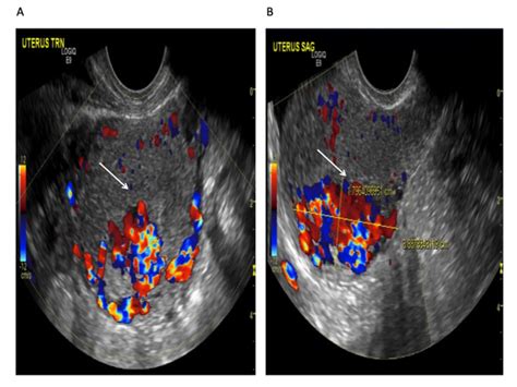 Cureus Acquired Uterine Arteriovenous Malformation Following