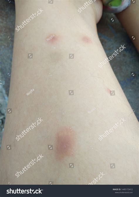 Sand Fly Bites On Human Leg Foto Stok Shutterstock