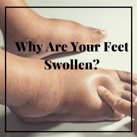 Why Are My Feet Swollen And Red At Night Printable Templates Protal