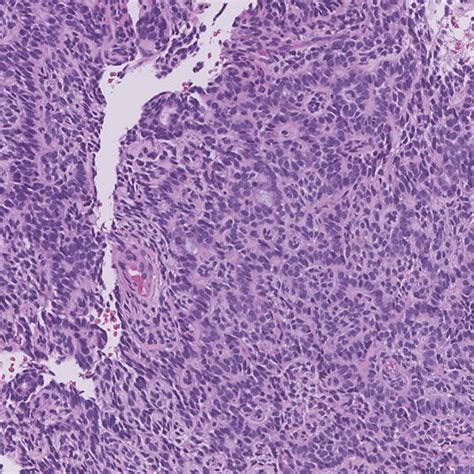Adenoid Cystic Carcinoma With Squamous Differentiation And Variant