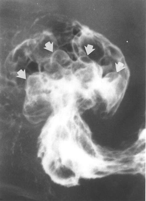 Giant Hyperplastic Polyps In The Stomach Radiographic Findings In Seven