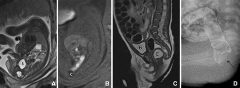 Rectal Duplication Cyst In A Male Fetus Sagittal T2 W A And T1 W B Download Scientific