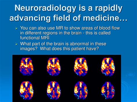 Ppt Neuroradiology Powerpoint Presentation Free Download Id401929