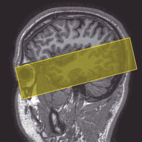 Axial Oblique Imaging Of The Temporal Lobes Slices Are Angled Parallel