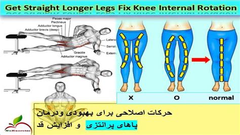 Get Straight Longer Legs Fix Knee Internal Rotation