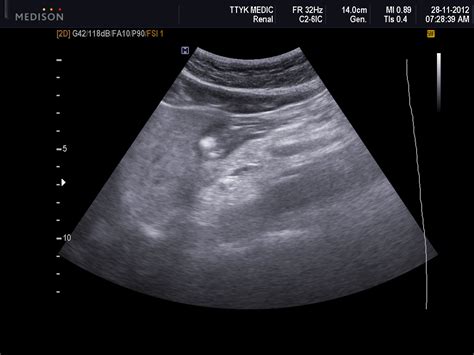 Vietnamese Medic Ultrasound Case 155 Gastric Ulcer On Ultrasound Dr