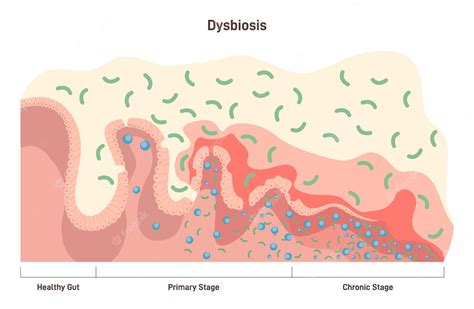 Dysbiosis 또는 Dysbacteriosis 단계 장 질환 불균형 프리미엄 벡터