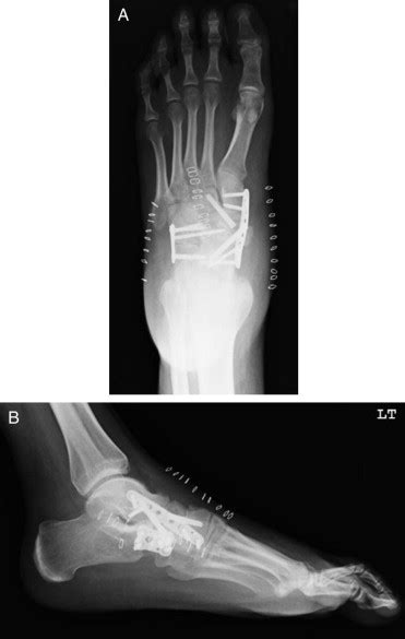 Vascularized Scapular Free Bone Graft After Nonunion Of A Tarsal