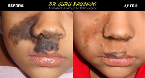 Congenital Nevus Removal Before And After