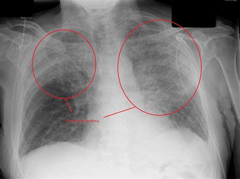 Pulmonary Edema Chf Chest X Ray