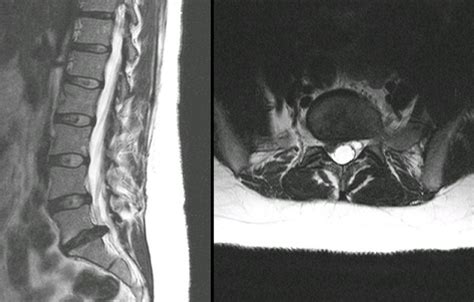 Herniated Disc Mri L S Lumbar Herniated Disc A More In Depth Look
