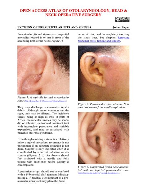 Excision Of Preauricular Pits And Sinuses Surgery Medical Specialties