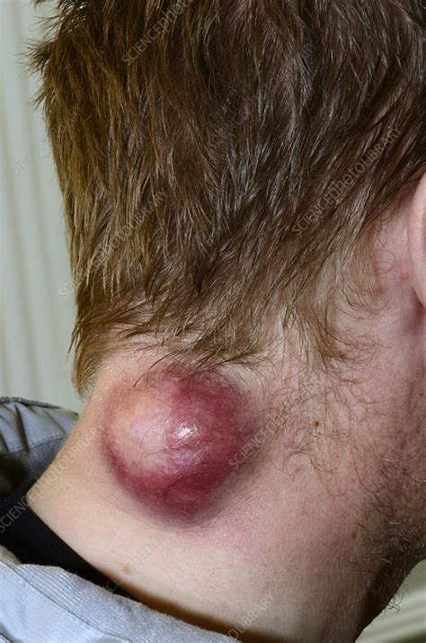 Infected Cyst On A Patients Neck Stock Image C014