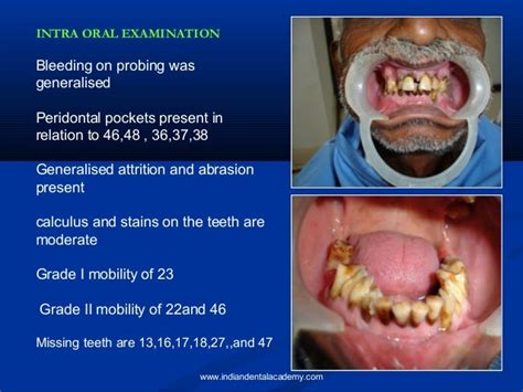 Oral Malignant Melanoma Prosthodontic Courses