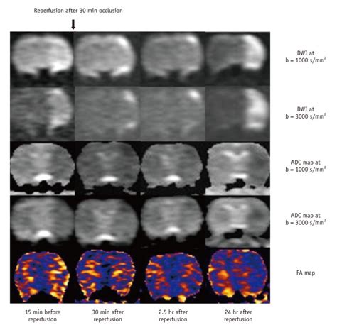 Serial Mri Patterns Of Transient Ischemia On Dwi And Adc Maps At B