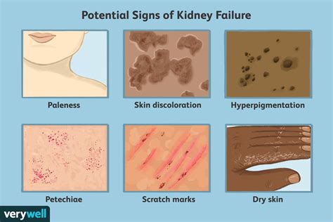 Acute Kidney Failure Causes Symptoms And Treatment Im