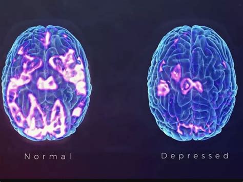 Cosa Succede Al Cervello Quando Una Persona Va In Depressione Brainbook