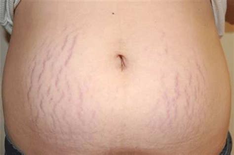 Exclusive Treatment For Stretchmarks