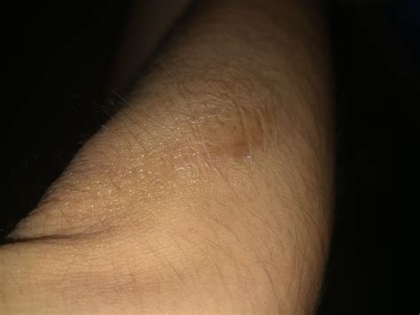 Anyone Can Suggest How To Remove This Dry Scaly Patch Of Skin On Both