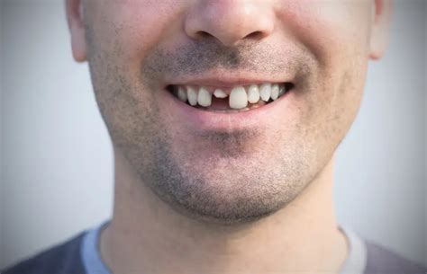 Pęknięty ząb i co dalej PrecisDENT Stomatologia Twój dentysta