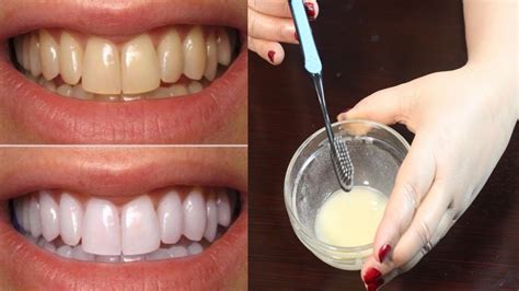 How To Whiten Teeth Best Teeth Whitening Method Teeth Whitening At Home Youtube