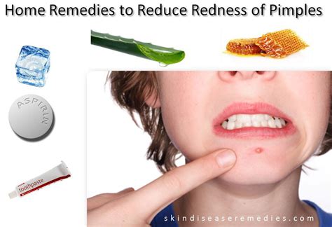 How To Reduce Acne Redness Cystic Acne Laser Treatment