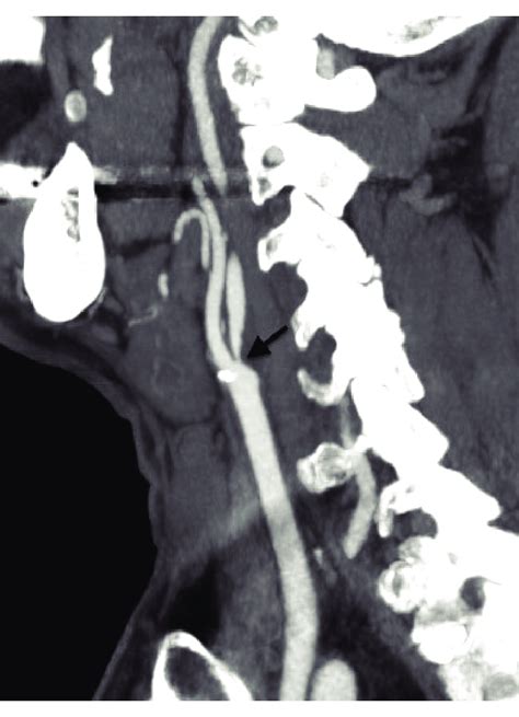This Single Ct Image Of The Carotid Artery Bifurcation Shows A Severe