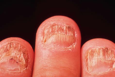 Pictures Of Skin Infections
