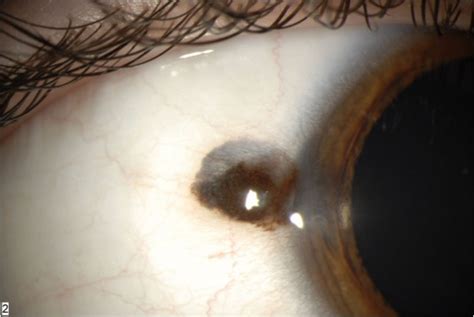 Conjunctival Melanocytic Tumors Eyewiki