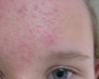 Les traitements de dermatologie au cabinet du Dr Gallay à Dijon