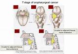 Images of Oropharyngeal Cancer Treatment