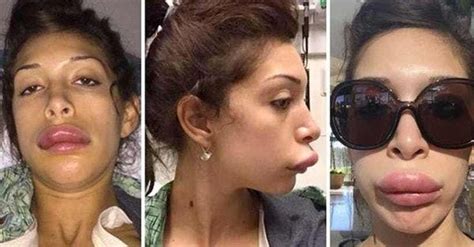 19 Freaky Cases Of Lip Injections Gone Wrong Lip Injections Lip
