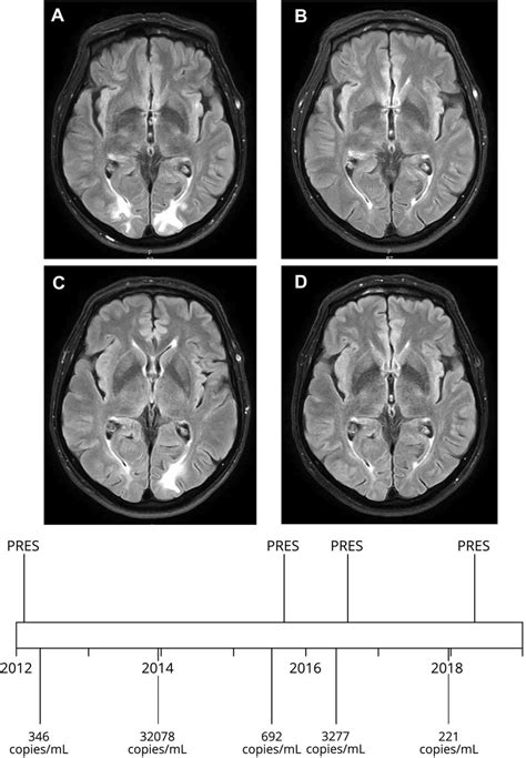 Figure Mri And Timeline Of Pres And Hiv Viral Load Flares Download
