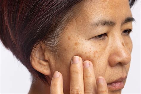 Melasma What Are The Best Treatments Bobthedungeonmaster