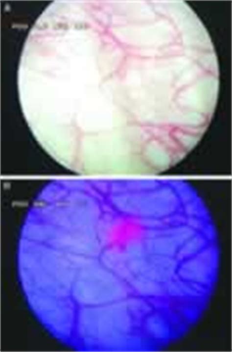 膀胱boukou urinary bladder 膀胱炎boukouen cystitis 膀胱結石boukoukesseki bladder stones 膀胱鏡boukoukyou cystoscope. 荧光膀胱镜可提升膀胱肿瘤诊疗效果